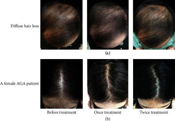 Scalp or Hair Botox (Alternate to Finasteride & PRP) - SKINFUDGE Aesthetics | Painless, No Side Effects, Natural Looking Results
