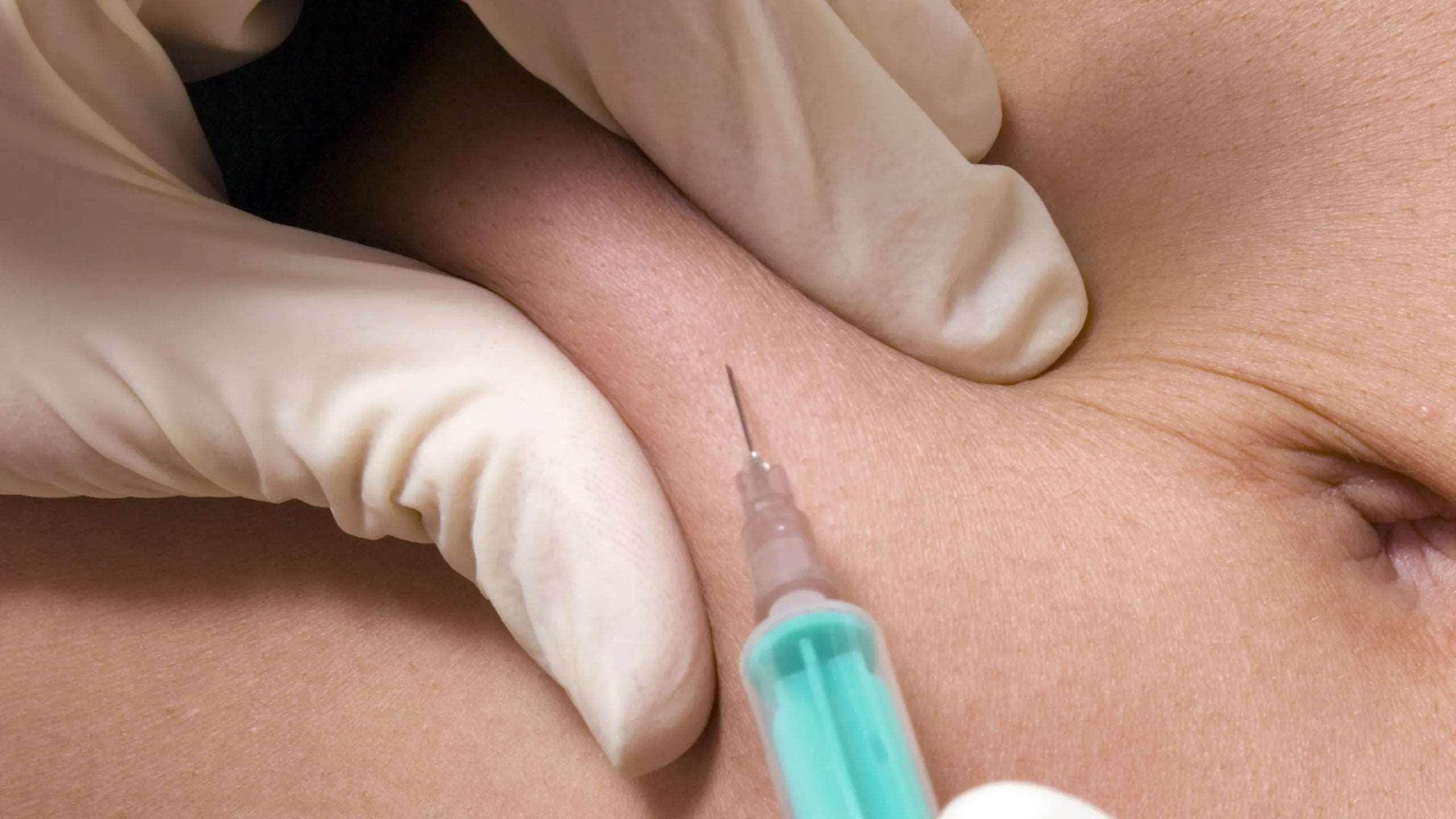 Fat Burning Injections (Fat Loss Injections - Site Specific) - SKINFUDGE Aesthetics | Painless, No Side Effects, Natural Looking Results