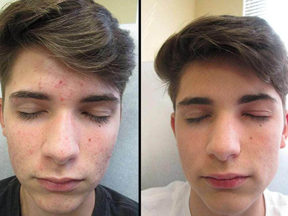 Acne Scars: Treatment Options - SKINFUDGE Aesthetics | Painless, No Side Effects, Natural Looking Results