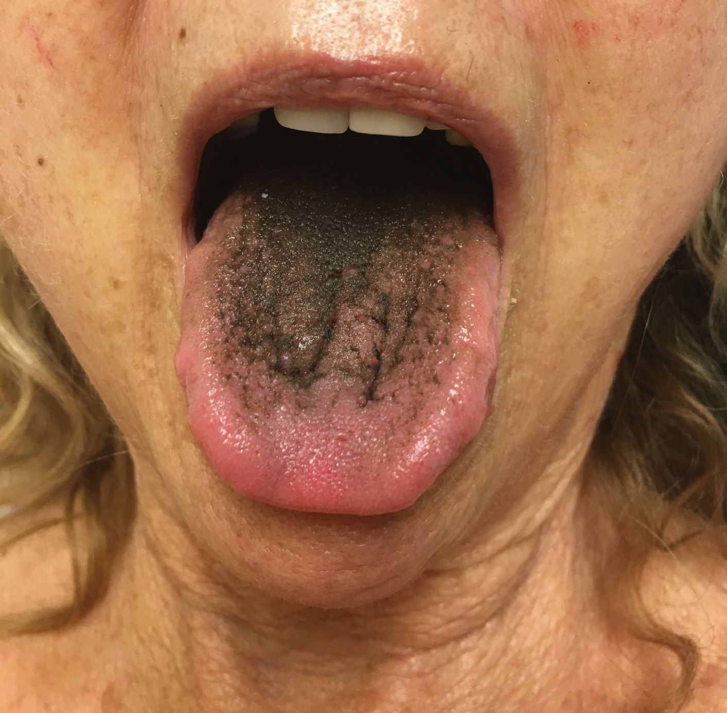 Laser Treatment for Tongue Papillae Pigmentation – SKINFUDGE Aesthetics