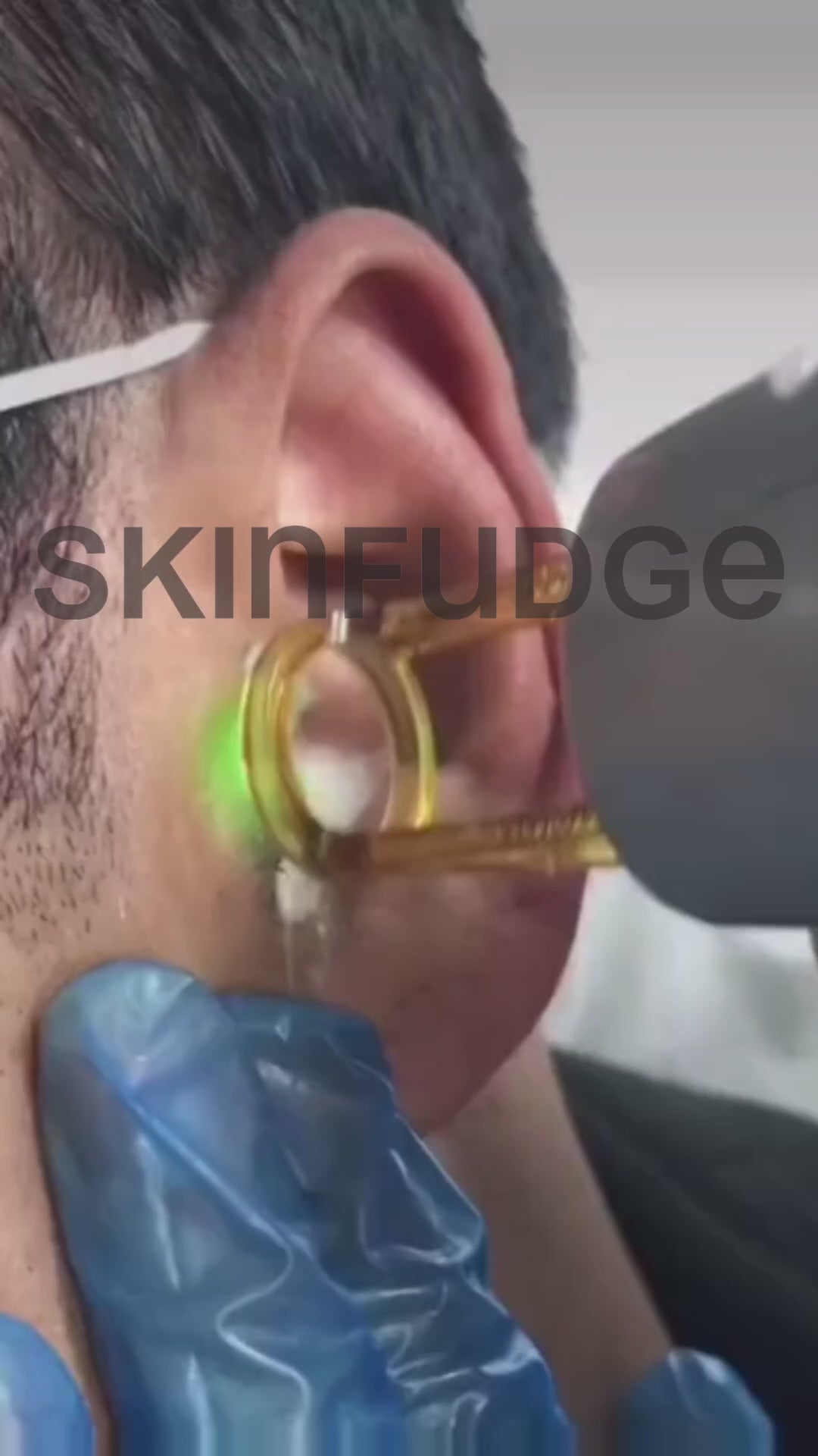 Male Ears Laser Hair Removal - Candela GentleYAG