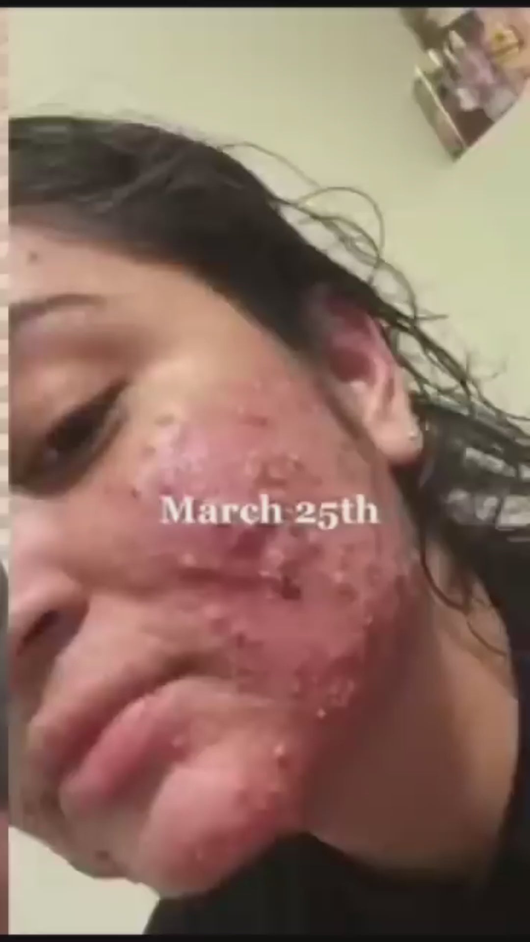 Acne Treatment Options