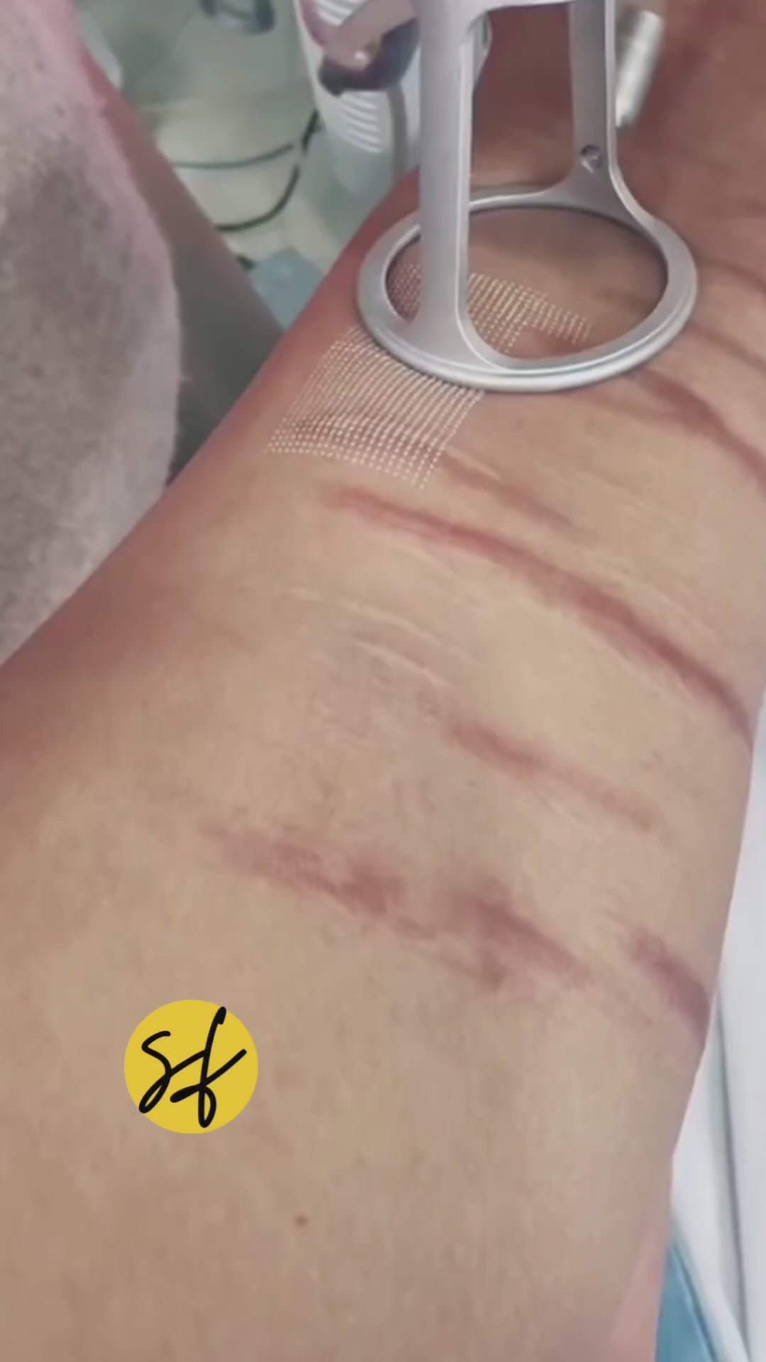 Self-Harm, Injury Marks Arm Scar Treatment with Fotona CO2 Laser