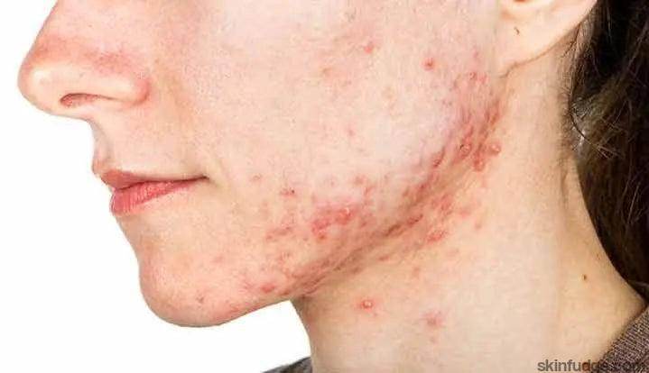 Acne Treatment Options - SKINFUDGE Aesthetics | Painless, No Side Effects, Natural Looking Results