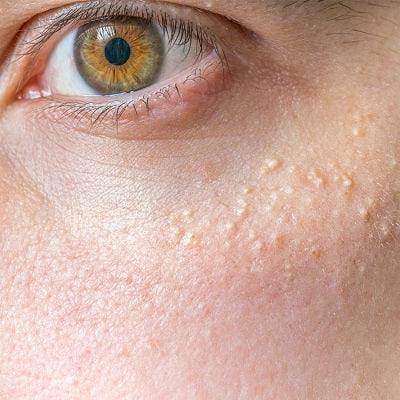 Syringoma Removal - SKINFUDGE Aesthetics | Painless, No Side Effects, Natural Looking Results