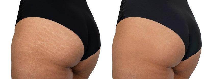 Stretch Marks Removal - SKINFUDGE Aesthetics | Painless, No Side Effects, Natural Looking Results