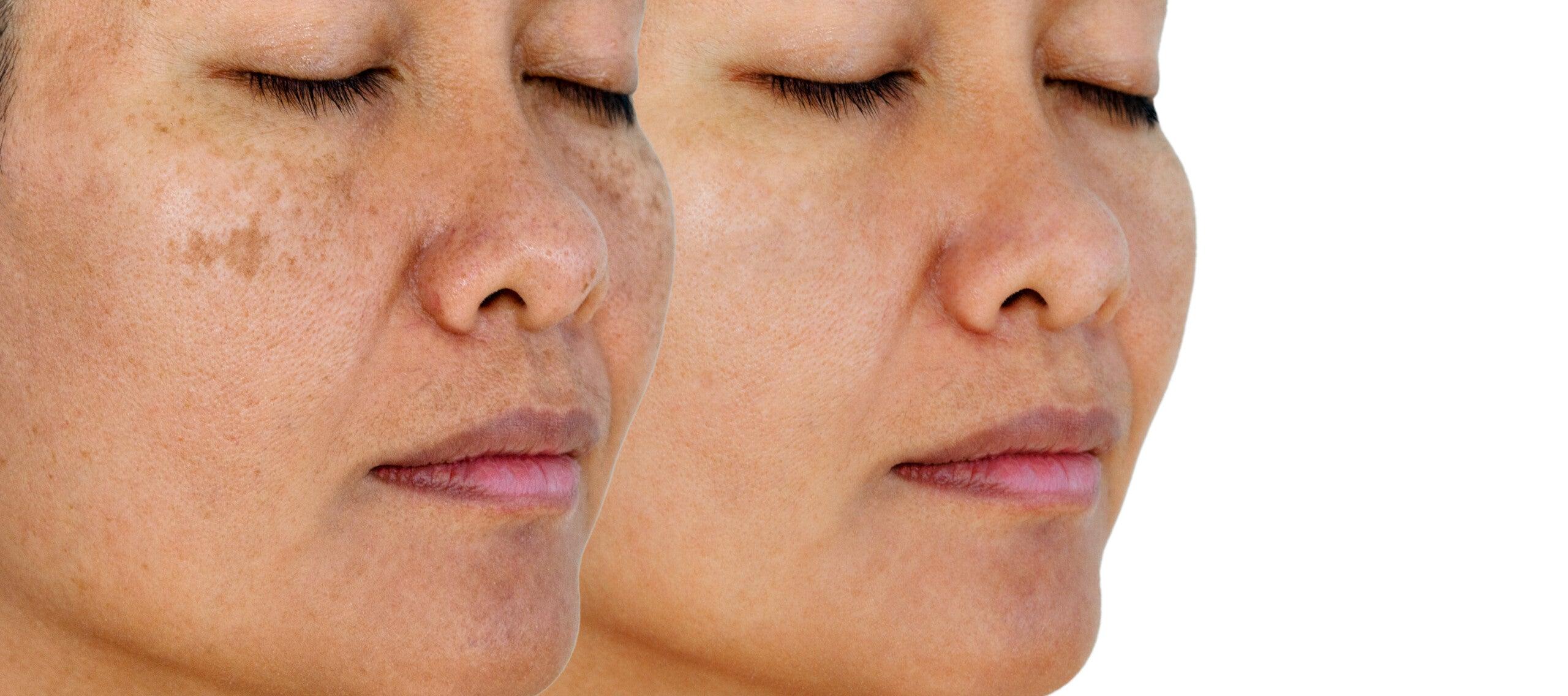 Laser Treatment Options For Hyper-pigmented Skin - SKINFUDGE Aesthetics | Painless, No Side Effects, Natural Looking Results