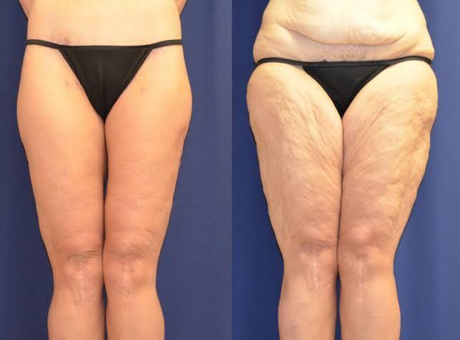 Liposuction Vs Cryolipolysis Differences And Side Effects - SKINFUDGE Aesthetics | Painless, No Side Effects, Natural Looking Results