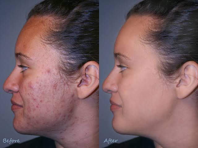 Acne Scar Filler Types And How Long They Last - SKINFUDGE Aesthetics | Painless, No Side Effects, Natural Looking Results
