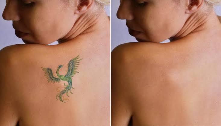Tattoo Removal Options in Lahore - SKINFUDGE Aesthetics | Painless, No Side Effects, Natural Looking Results