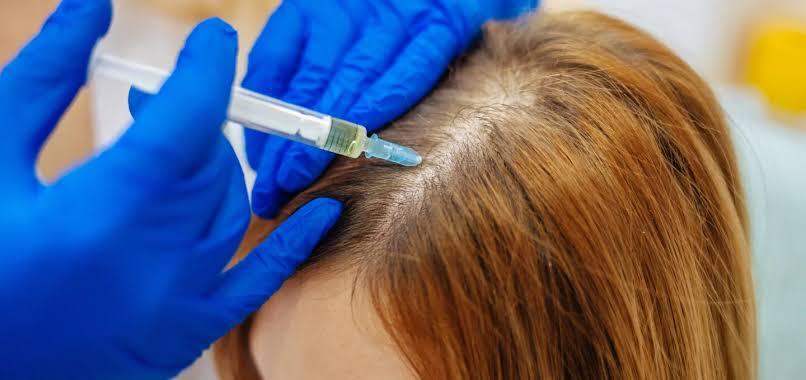 Can PRP / PRF Grow Hair on Bald Scalp? - SKINFUDGE Aesthetics | Painless, No Side Effects, Natural Looking Results