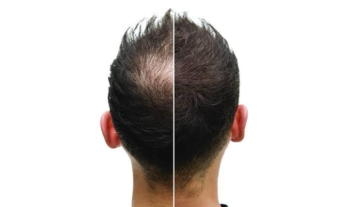 Effect of Adding Biotin To PRP/PRF Session For Hair Regrowth - SKINFUDGE Aesthetics | Painless, No Side Effects, Natural Looking Results