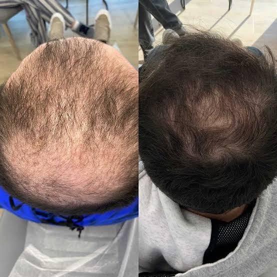 5 benifits of getting PRF for hair restoration - SKINFUDGE Aesthetics | Painless, No Side Effects, Natural Looking Results