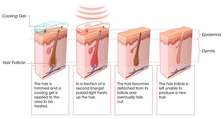 What is The Best Laser Hair Removal Method? - SKINFUDGE Aesthetics | Painless, No Side Effects, Natural Looking Results
