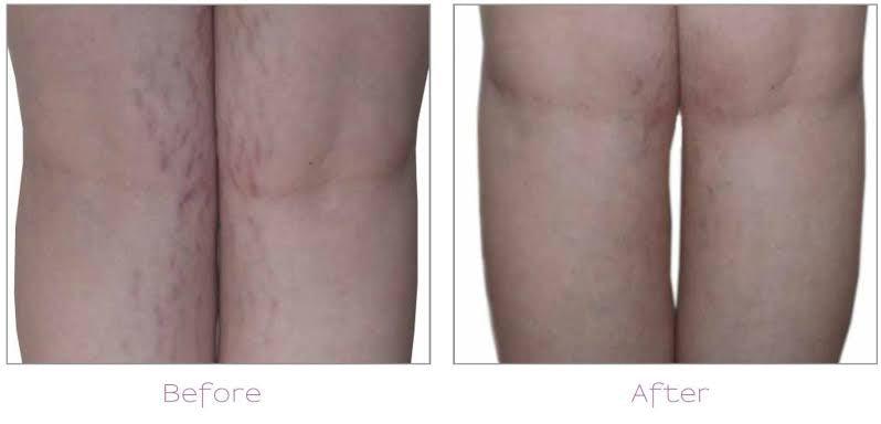 Can Laser Hair Removal Tighten the Skin? - SKINFUDGE Aesthetics | Painless, No Side Effects, Natural Looking Results