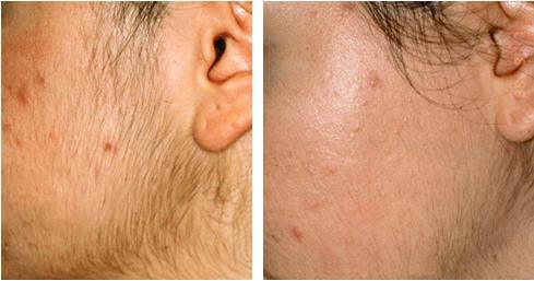 Does Laser Hair Removal Work On Black Hair? - SKINFUDGE Aesthetics | Painless, No Side Effects, Natural Looking Results