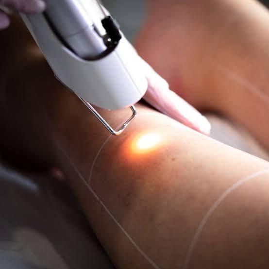 How to get best laser hair removal services? - SKINFUDGE Aesthetics | Painless, No Side Effects, Natural Looking Results