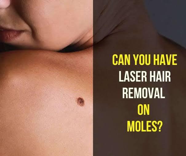Will Laser Hair Removal Hurt the Skin Around a Mole? - SKINFUDGE Aesthetics | Painless, No Side Effects, Natural Looking Results