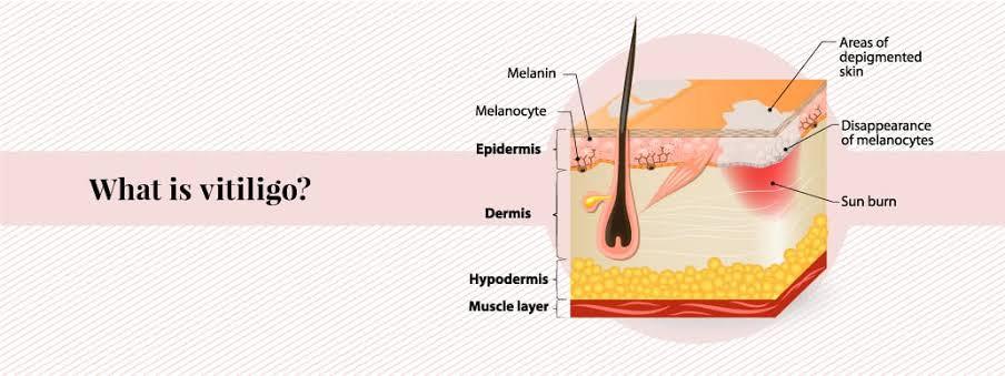 Can You Do Laser Hair Removal If you Have Vitiligo? - SKINFUDGE Aesthetics | Painless, No Side Effects, Natural Looking Results