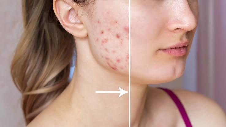 Can Laser Hair Removal Cause Acne on the Face? - SKINFUDGE Aesthetics | Painless, No Side Effects, Natural Looking Results