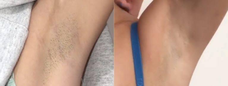 How Long Does Laser Hair Removal Last? - SKINFUDGE Aesthetics | Painless, No Side Effects, Natural Looking Results