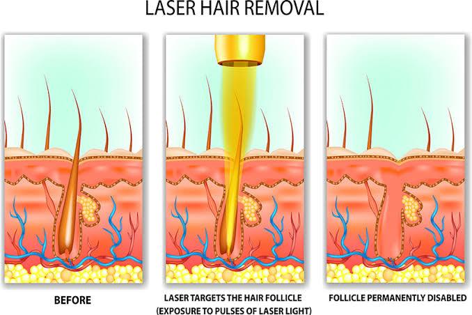 How many laser treatments are there to remove hair? - SKINFUDGE Aesthetics | Painless, No Side Effects, Natural Looking Results