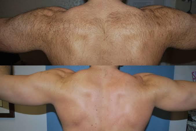Is Laser Hair Removal Permanent? Are There Any Side Effects? - SKINFUDGE Aesthetics | Painless, No Side Effects, Natural Looking Results