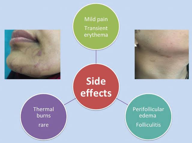 What Are The Side Efects of Laser Hair Removal? - SKINFUDGE Aesthetics | Painless, No Side Effects, Natural Looking Results