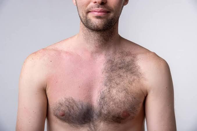 Does laser hair removal work on men? Is it permanent? - SKINFUDGE Aesthetics | Painless, No Side Effects, Natural Looking Results