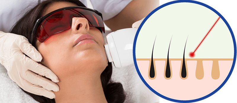 Can I use laser hair removal treatment on my face? - SKINFUDGE Aesthetics | Painless, No Side Effects, Natural Looking Results