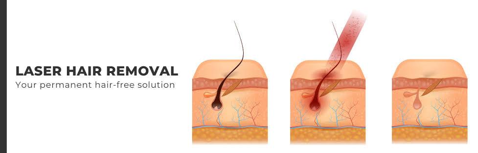 Can men get permanent facial hair removal done by laser? - SKINFUDGE Aesthetics | Painless, No Side Effects, Natural Looking Results