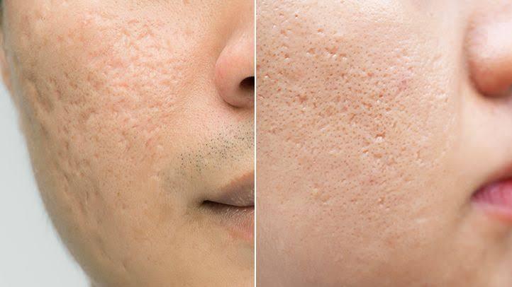 What are the best laser treatments for acne scars? - SKINFUDGE Aesthetics | Painless, No Side Effects, Natural Looking Results
