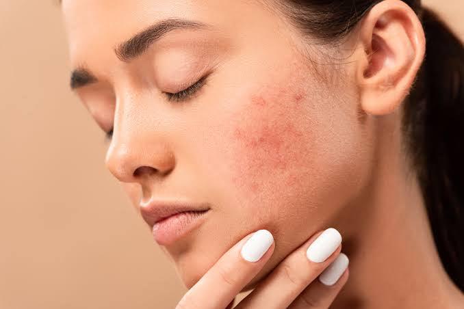 What is the best treatment for acne scar on a full face? - SKINFUDGE Aesthetics | Painless, No Side Effects, Natural Looking Results