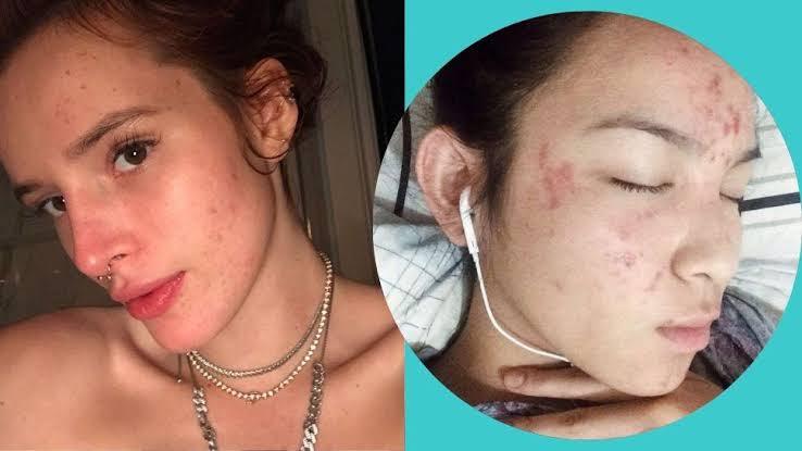 How do celebrities get rid of acne scars? - SKINFUDGE Aesthetics | Painless, No Side Effects, Natural Looking Results