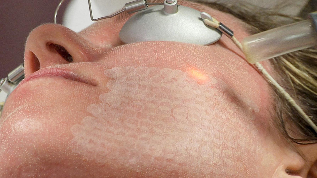 What are the latest treatments for acne scars? - SKINFUDGE Aesthetics | Painless, No Side Effects, Natural Looking Results