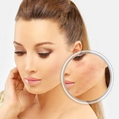 What kind of treatment works for acne scars? - SKINFUDGE Aesthetics | Painless, No Side Effects, Natural Looking Results