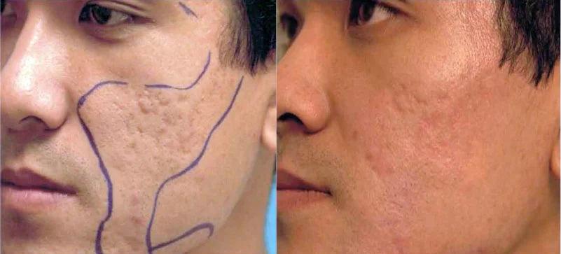 Is it safe to use laser treatment for acne scars? - SKINFUDGE Aesthetics | Painless, No Side Effects, Natural Looking Results