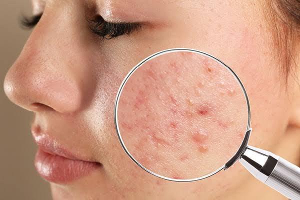 What is the best treatment for pitted acne scars? - SKINFUDGE Aesthetics | Painless, No Side Effects, Natural Looking Results