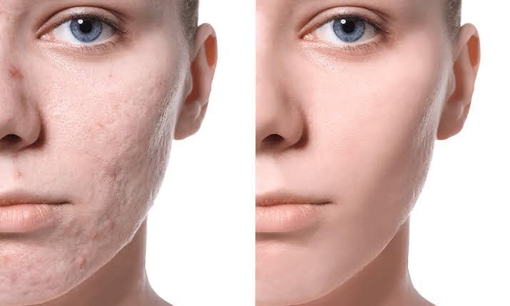 How does acne scar treatment work? - SKINFUDGE Aesthetics | Painless, No Side Effects, Natural Looking Results