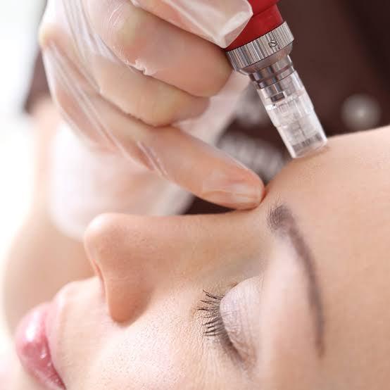 How can I get rid of my acne scars beside laser treatment? - SKINFUDGE Aesthetics | Painless, No Side Effects, Natural Looking Results