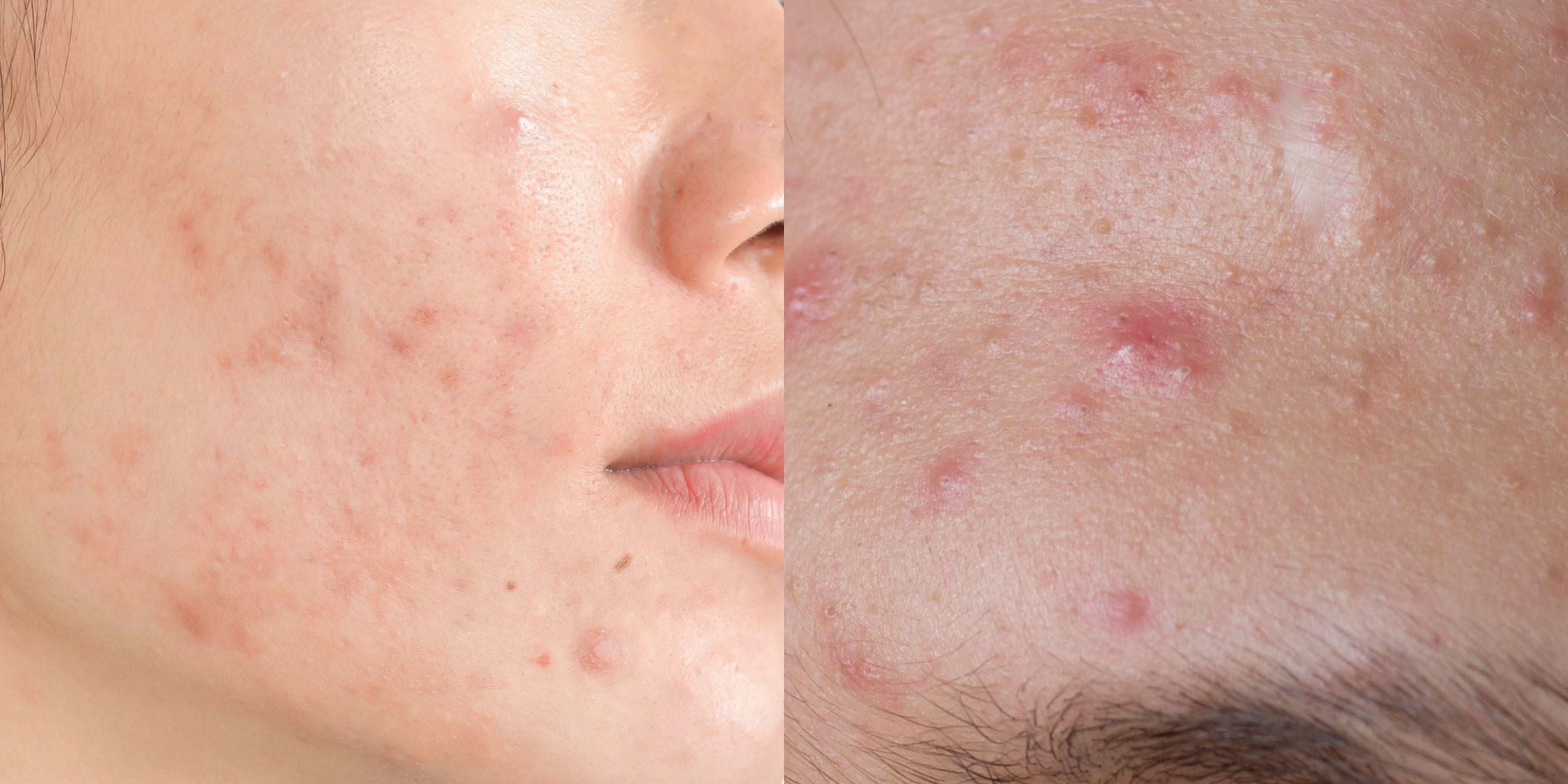 How To Minimise The Risk Of Acne or Skin Issues From Makeup? Consider the Following Tips: - SKINFUDGE Aesthetics | Painless, No Side Effects, Natural Looking Results