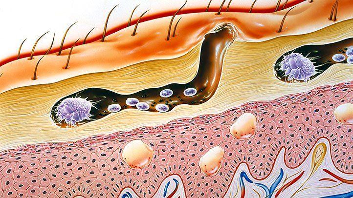 After Treatment Instructions for Scabies Infection - SKINFUDGE Aesthetics | Painless, No Side Effects, Natural Looking Results