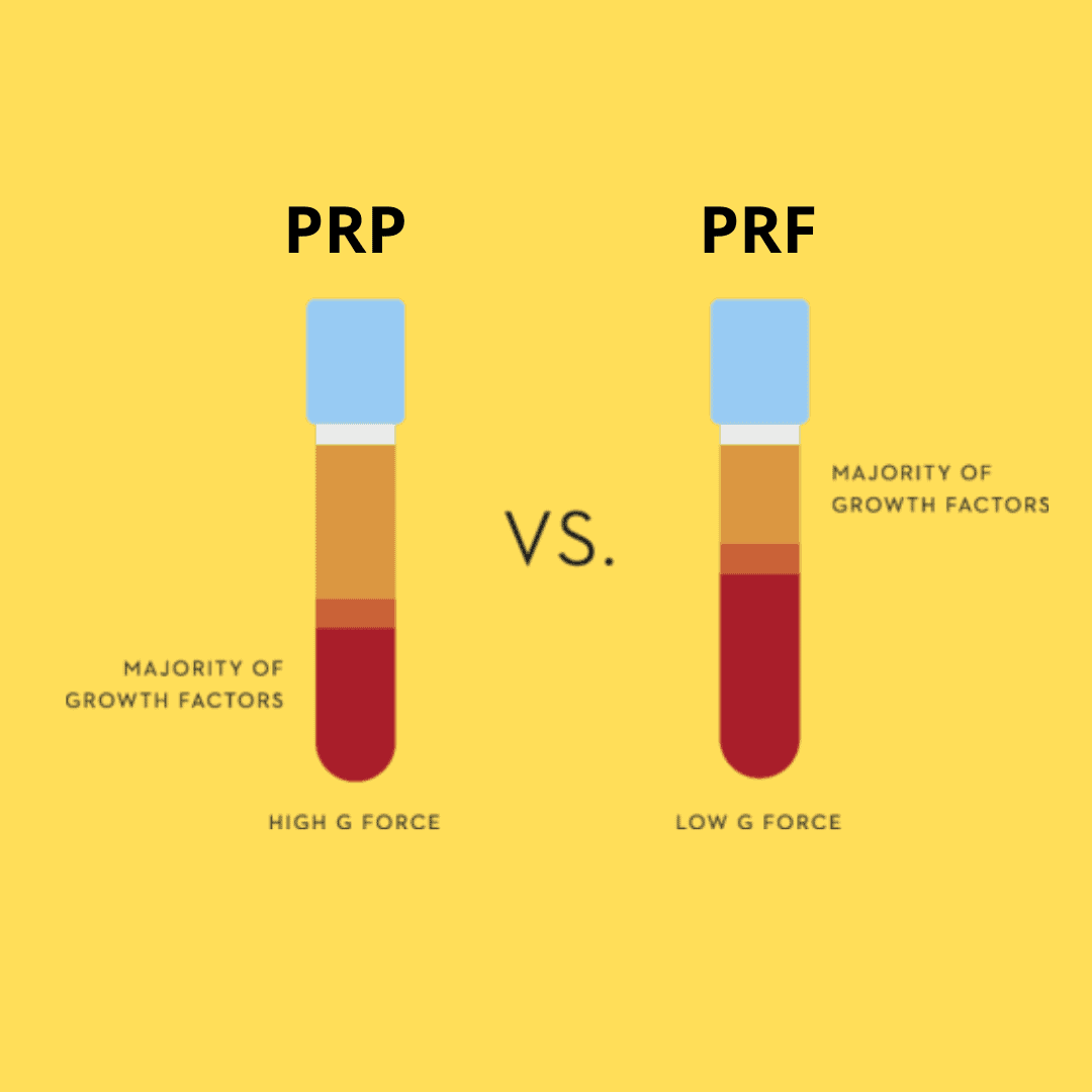 Difference Between PRP, PRF and PRGF - SKINFUDGE Aesthetics | Painless, No Side Effects, Natural Looking Results