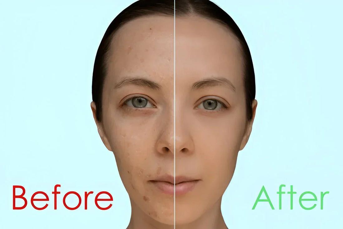 Which Chemical Peel Is Best for Skin Whitening?