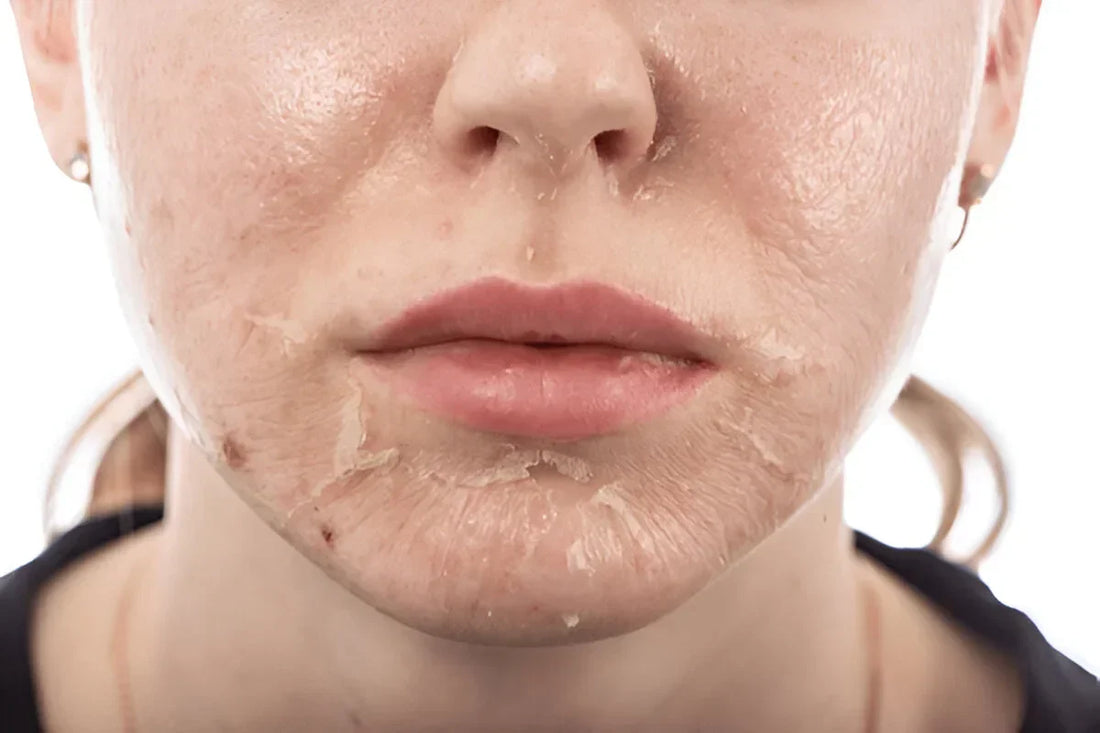 What Chemical Peel Does to Your Skin