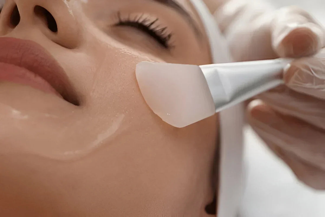 Can Chemical Peels Remove Acne Scars?