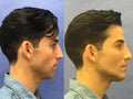 Jawline Contouring - SKINFUDGE Aesthetics | Painless, No Side Effects, Natural Looking Results