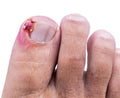 Ingrown Toenail Treatment - SKINFUDGE Aesthetics | Painless, No Side Effects, Natural Looking Results