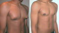 The Ultimate Guide to Gynecomastia Surgery Cost in Pakistan: 5 Key Factors to Consider - SKINFUDGE Aesthetics | Painless, No Side Effects, Natural Looking Results