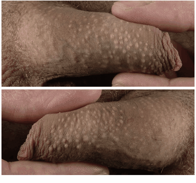 Fordyce Spot Removal - SKINFUDGE Aesthetics | Painless, No Side Effects, Natural Looking Results